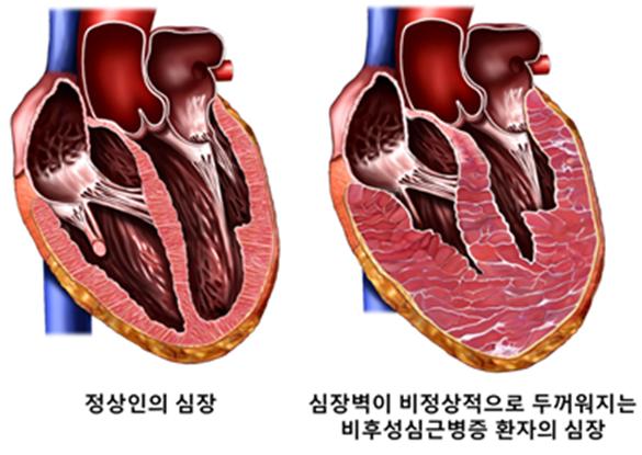 정상인의 심장보다 심장벽이 두꺼워지는 비후성심근병증 환자의 심장