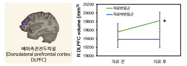 항우울제 치료 전후 배외측 전전두피질 부피의 변화