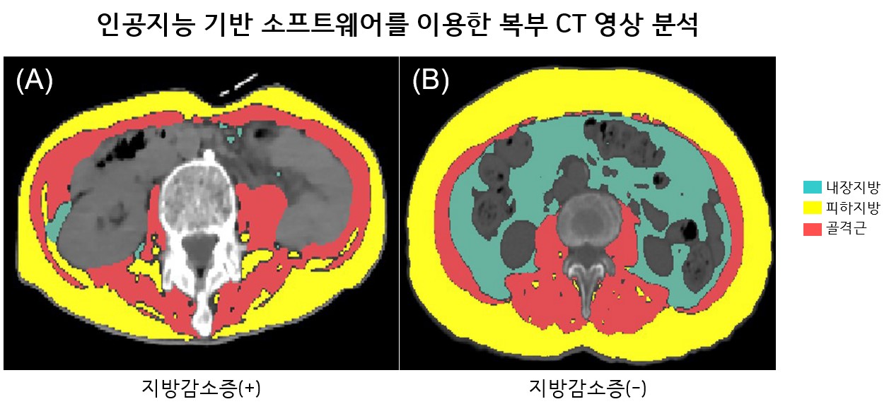 루게릭병 환자의 CT사진