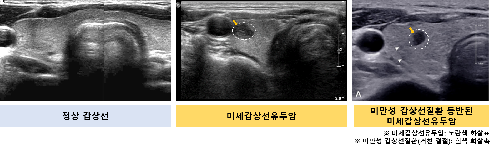 갑상선 초음파 비교