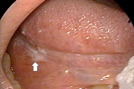  持续的白斑症，可能是口腔癌的征兆。