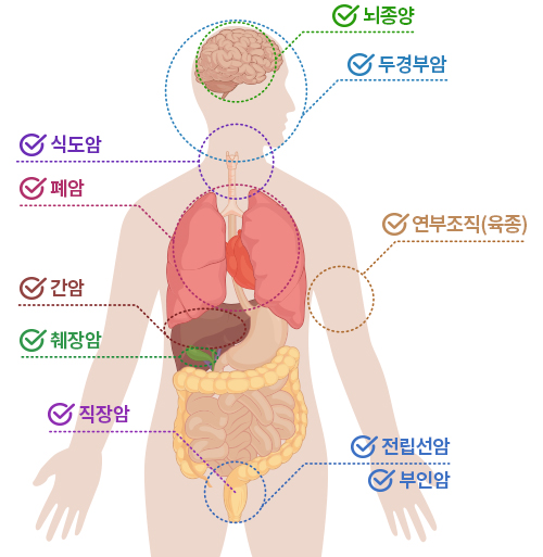 대상암종