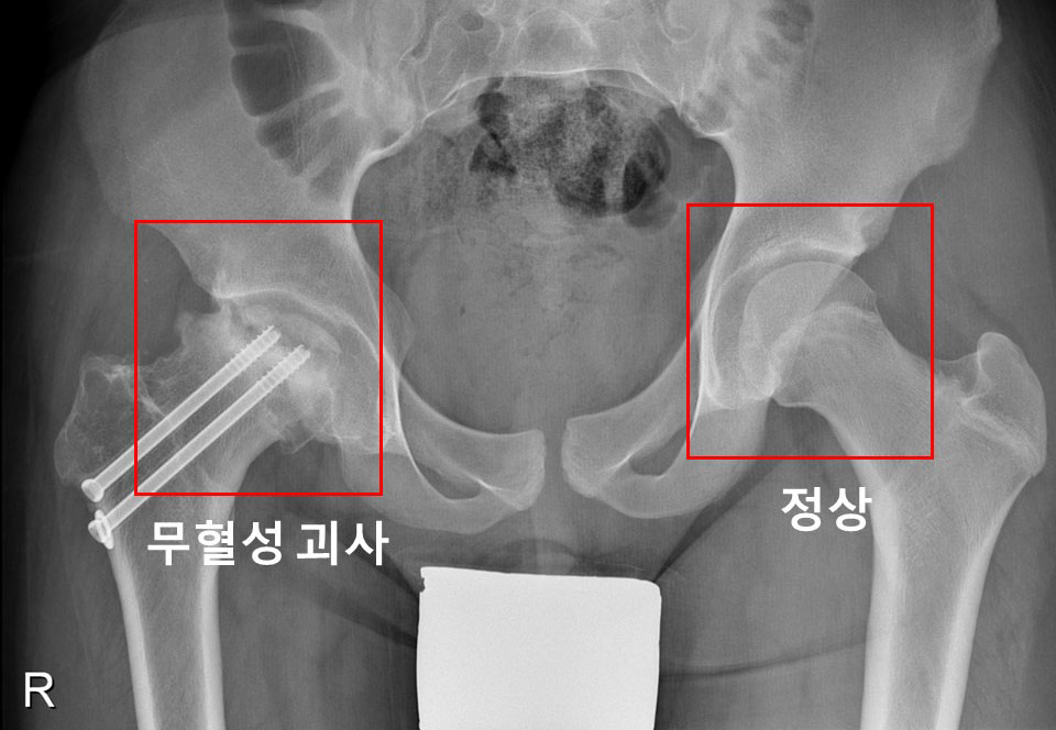 무혈성 괴사