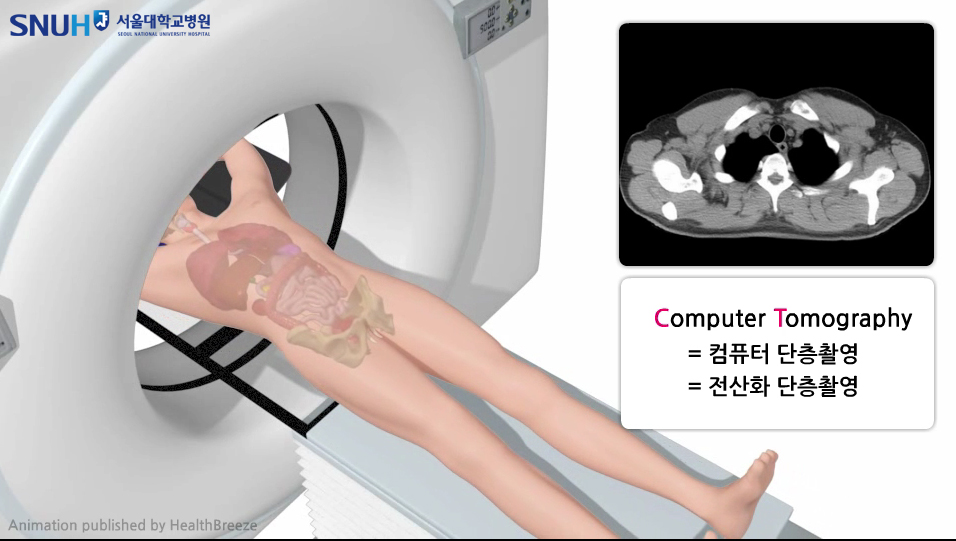 저선량 흉부CT 검사 모식도