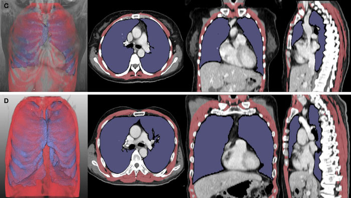 루게릭병-환자의-흉부-CT-분석-결과 루게릭병-환자의-흉부-CT-분석-결과