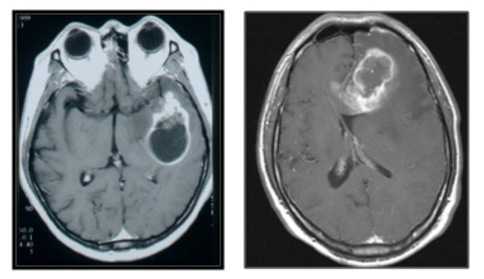 [자료] 악성 뇌종양(교모세포종) MRI