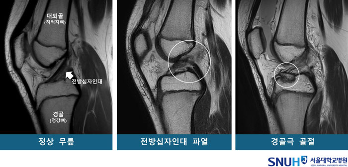 [웹그림]-정상-무릎-및-무릎-부상-환자의-MRI_250806