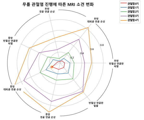 [그래프] 무릎 관절염 진행에 따른 MRI 소견
