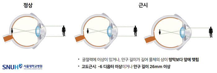 [자료1] 근시와 고도근시