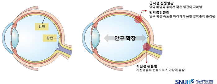 [자료2] 고도근시 눈의 안구확장