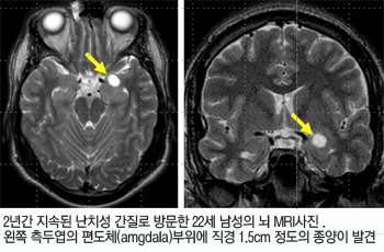 2Ⱓ ӵ ġ  湮 22   MRI.  ο ü(amgdala)  1.5cm   ߰