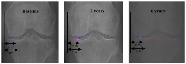 [병원뉴스]서울대병원-동국대일산병원, AI로 무릎 골관절염 '최대 마모 지점' 정밀 진단한다