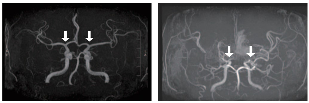 [병원뉴스]서울대병원, 소아 모야모야병 진단·예후 예측 바이오마커 발견