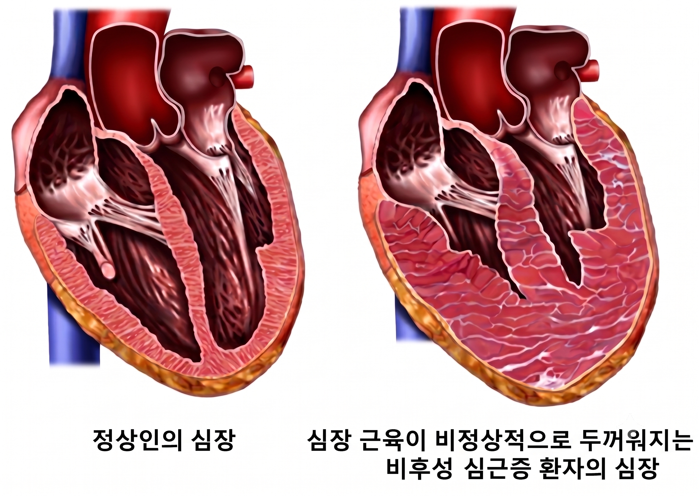[병원뉴스]저·중간 위험' 비후성 심근증, 좌심방 지표 LARS 21% 미만이면 돌연사 관련 사건 위험 약 6배