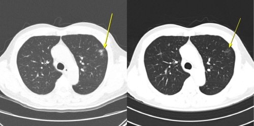 [병원뉴스]서울대병원, “증상 없어도 영상에서 보이는 면역관련 이상반응, 간세포암 면역치료 예후와 연관”