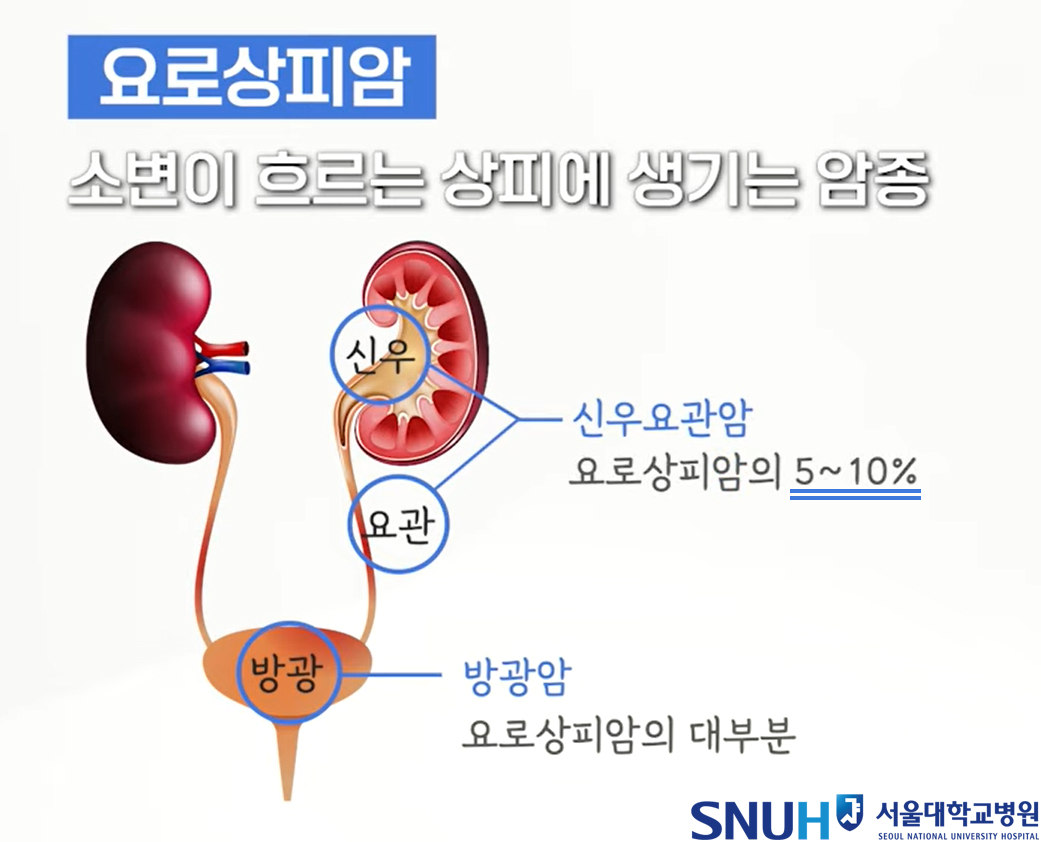 [병원뉴스][SNUH건강정보] 미지의 암,'신우요관암'