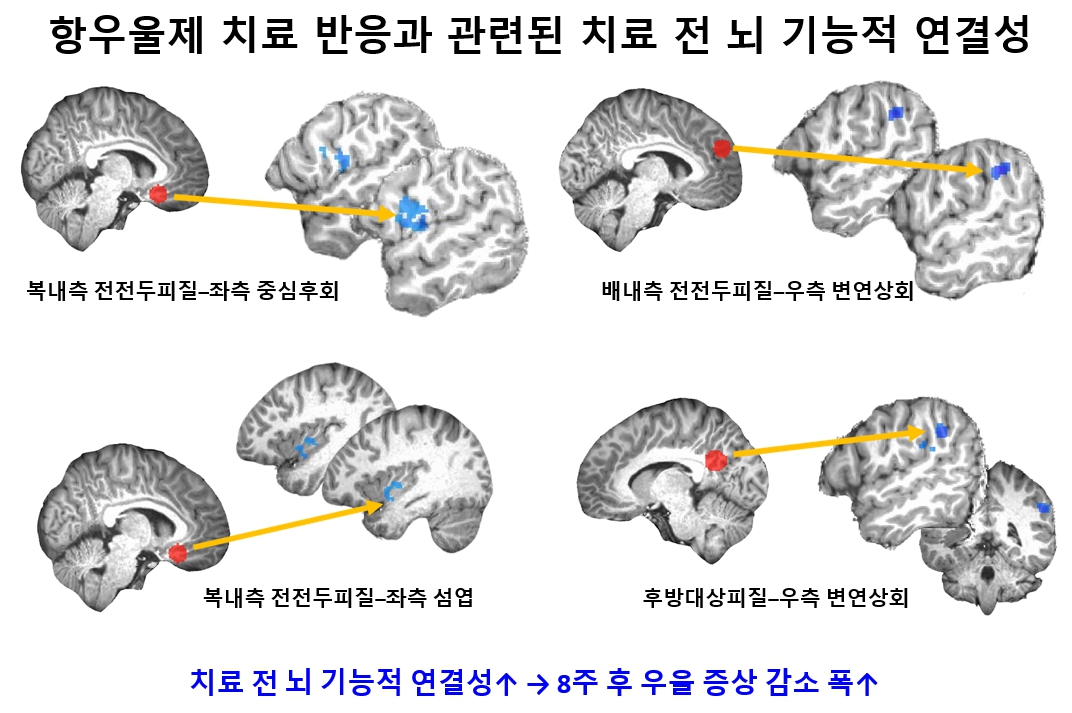 [병원소식]청소년 우울증 항우울제 치료 반응, 치료 전 '뇌 기능적 연결성'으로 예측한다
