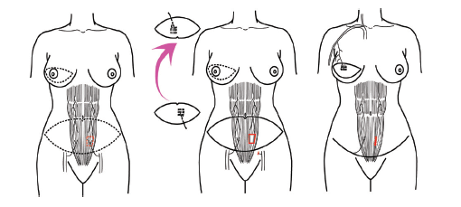 37+ 영상 유륜 타투 20 수술치료 | 서울대학교병원