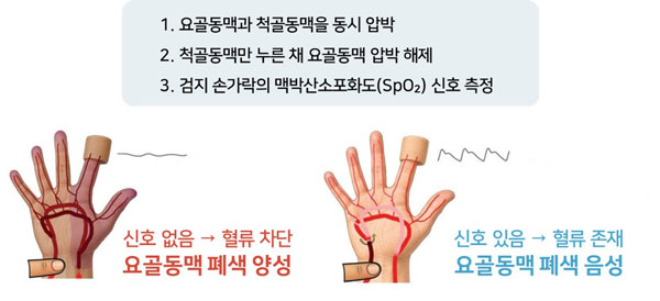 [자료] 영유아 요골동맥 폐색 검사법