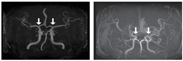 [사진 왼쪽부터] 정상 및 모야모야병 환자의 뇌혈관