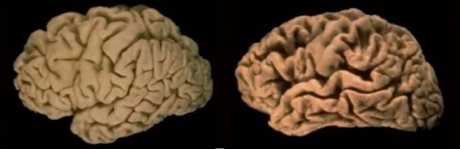 [그림 왼쪽부터] 정상적인 뇌, 알츠하이머병 환자의 뇌