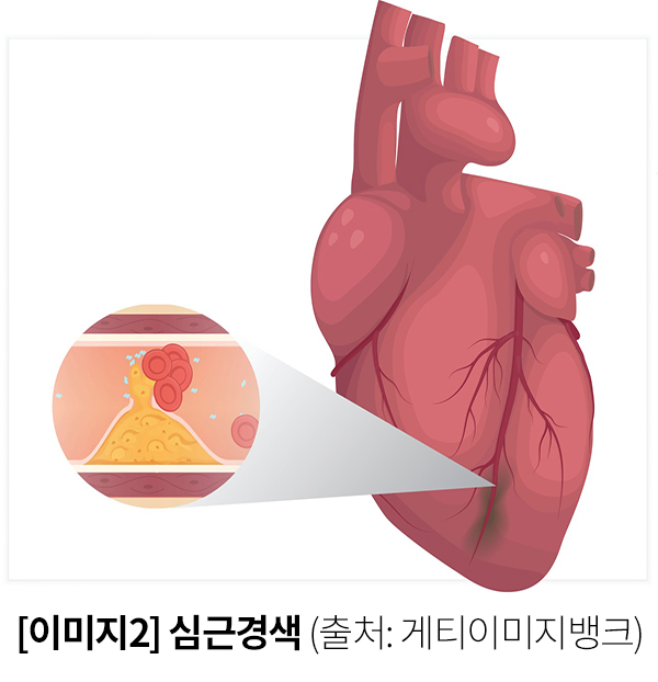 [이미지2] 심근경색 (출처: 게티이미지뱅크)