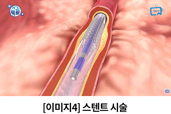 [이미지4] 스텐트 시술