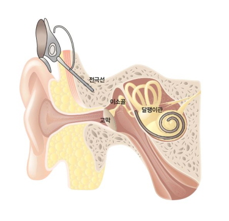 [이미지] 인공와우 전극 삽입 구조도