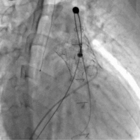 [사진2] 경피적 폐동맥판막 치환술(PPVI) 시술 장면.
