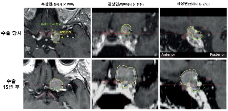 [그림1] 55세 여성 환자의 시신경 인접 수막종 수술 당시(상단)와 15년 후(하단) MRI 영상.