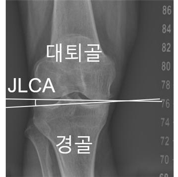 [사진] 무릎 관절선 수렴각(JLCA)
