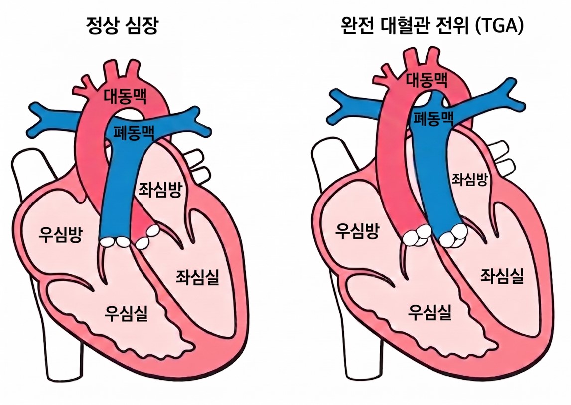 [이미지] 정상 심장과 완전 대혈관 전위