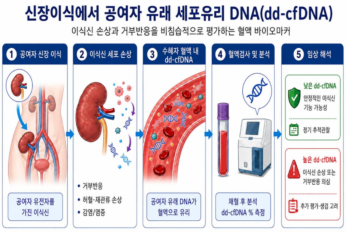 [그림] 신장이식 후 이식신 손상으로 혈액 내에 증가한 &lsquo;세포유리 DNA&rsquo;를 측정해 거부반응 위험을 비침습적으로 평가하는 원리 모식도