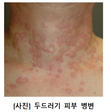 [사진] 두드러기 피부 병변