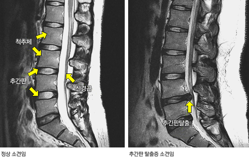 요추 MRI 영상