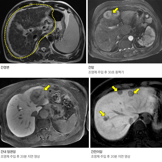 간 MRI 영상