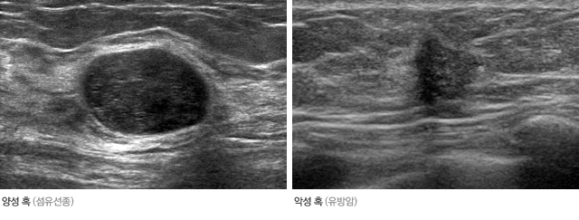 유방 초음파 영상