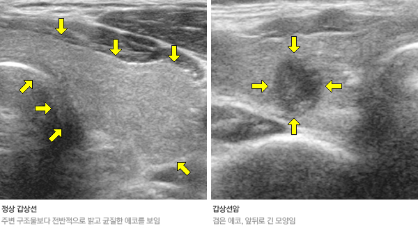 갑상선 초음파 영상