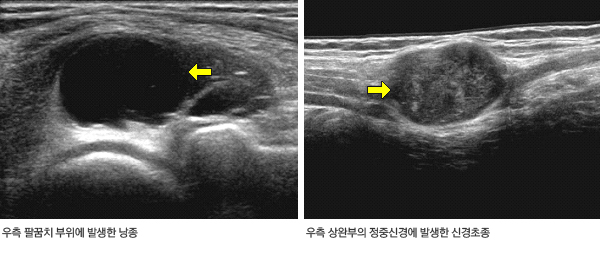 근골격계 초음파 영상