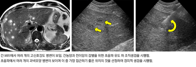 간농양의 초음파 유도 하 조직 생검