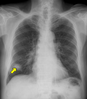 흉부 X선에서 보이는 폐암