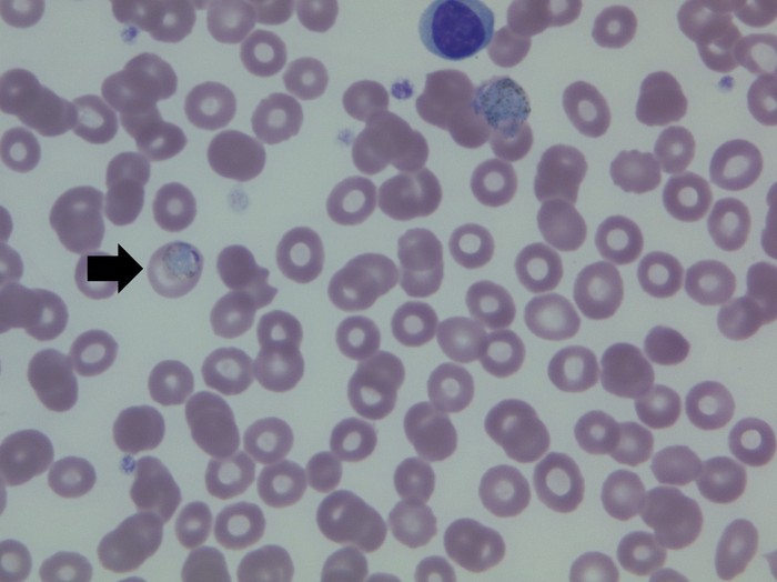 말라리아 환자 말초혈액도말검사