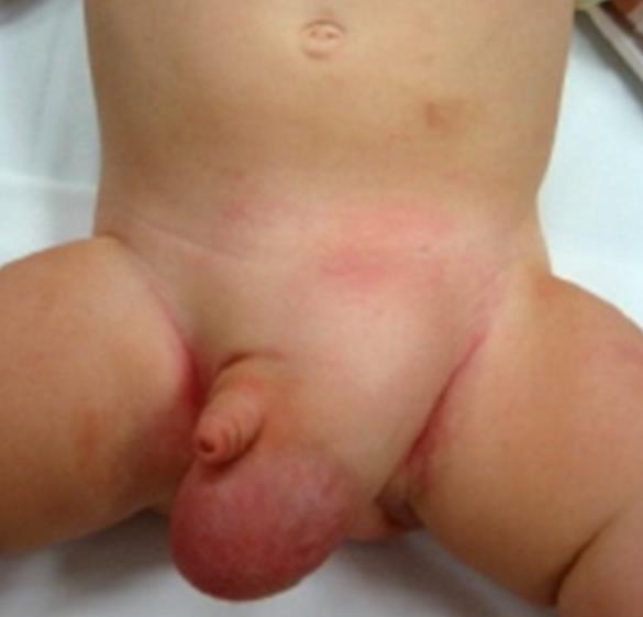 좌측 서혜부 탈장