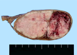 고환암이 발생한 고환의 절단면 모습