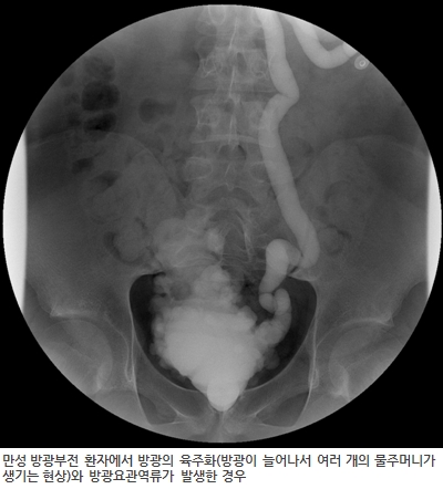 만성 방광부전