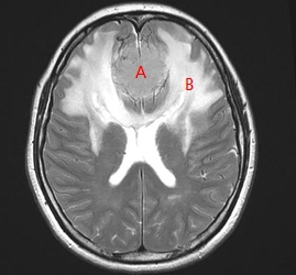 MRI 상에 나타난 뇌종양(A) 주변의 뇌부종(B)