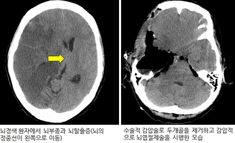 뇌경색 환자에서 뇌부종