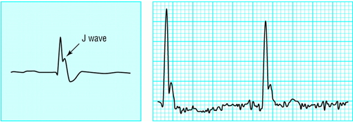 저체온증 환자에서 나타나는 J 파(Osborn wave)