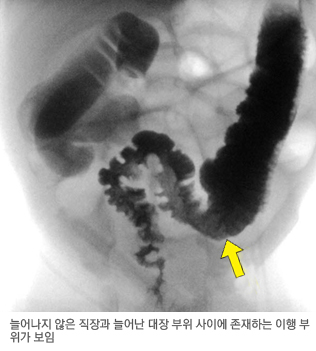 대장조영술에서 관찰된 히르슈슈프룽씨병