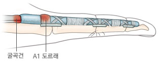 손가락 굽힘힘줄의 방추성 비대와 와 A1 도르래의 비후